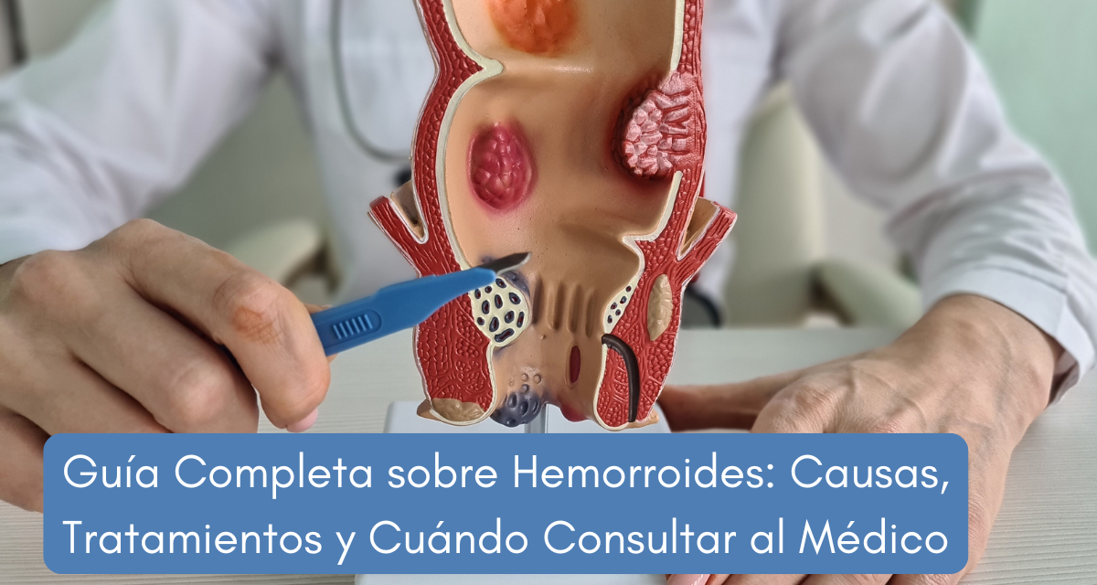 Guía Completa sobre Hemorroides: Causas, Tratamientos y Cuándo Consultar al Médico